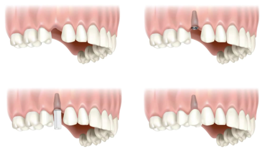 DENTAL-IMPLANT-SURGERY