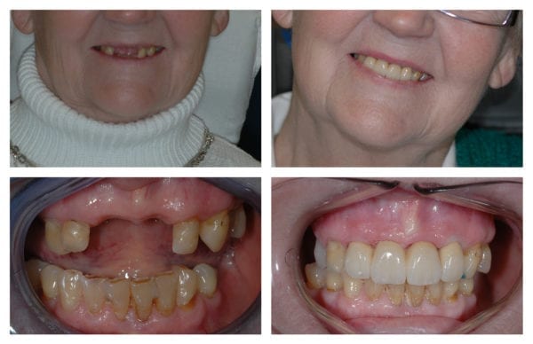 denture-implant